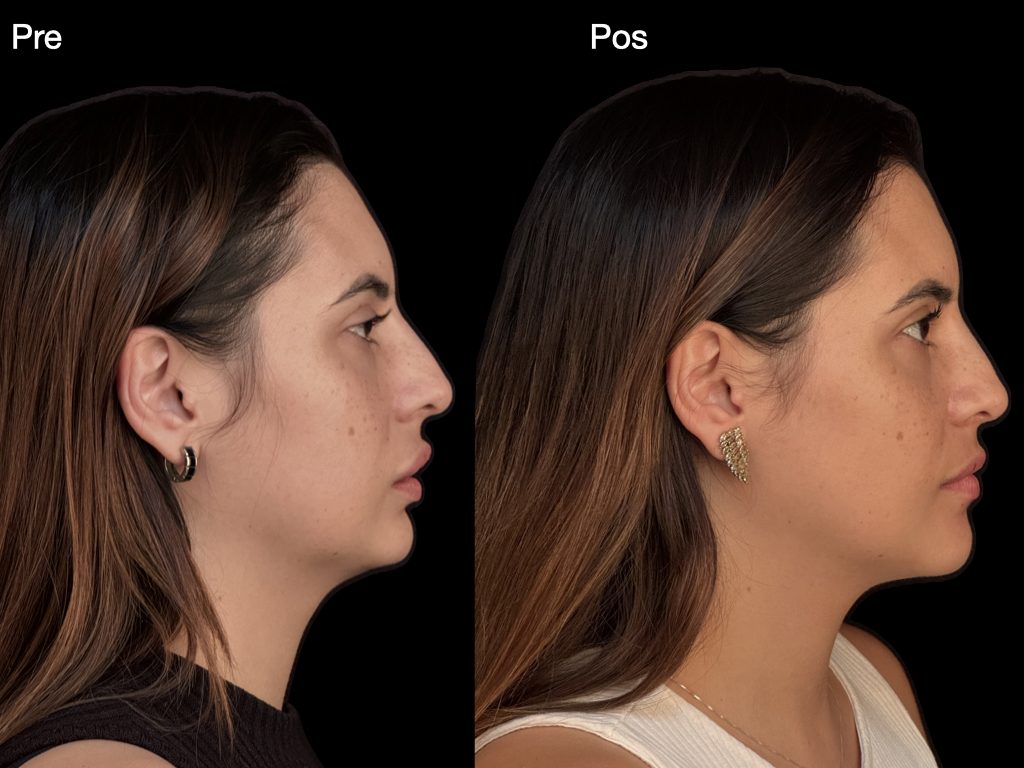 Cirurgia ortognática — vista em três quartos, registro clínico