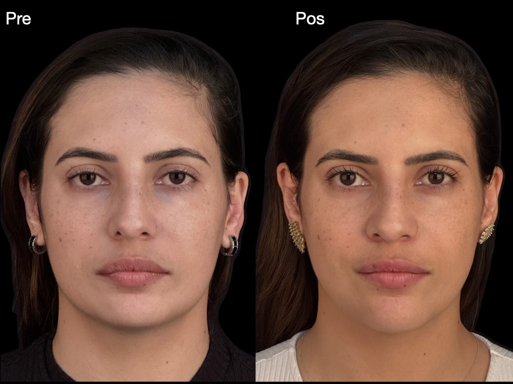 Cirurgia ortognática — vista frontal, registro clínico