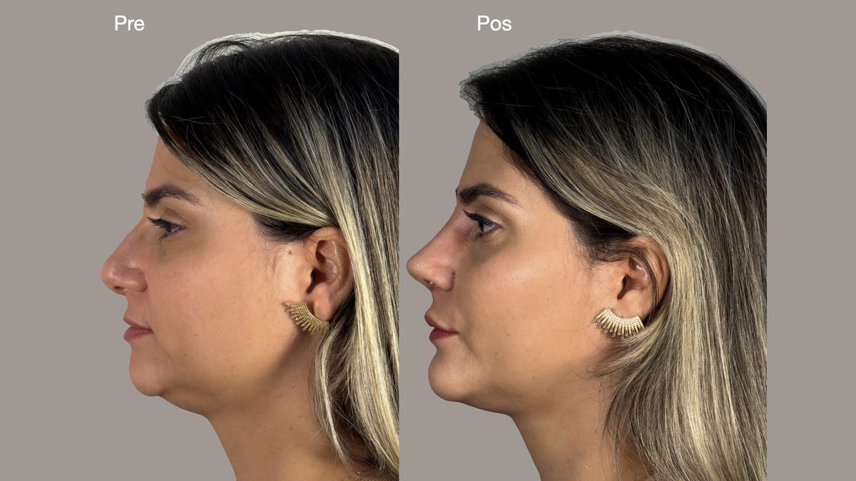 Mentoplastia — vista de perfil, registro clínico