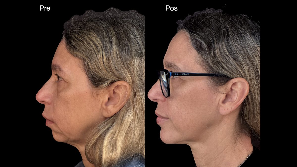 Cirurgia ortognática — vista de perfil, registro clínico