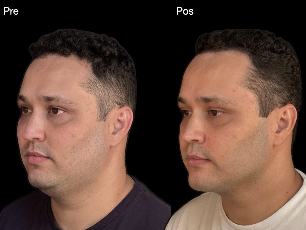 Cirurgia ortognática — vista em três quartos, registro clínico
