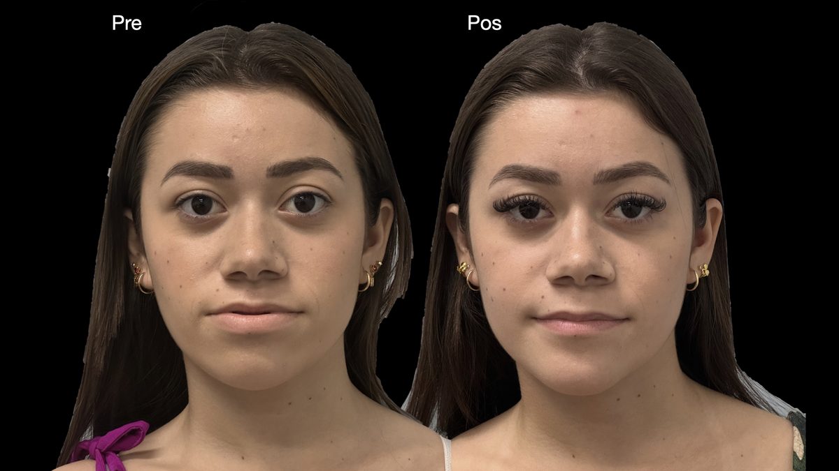 Cirurgia ortognática — vista frontal, registro clínico