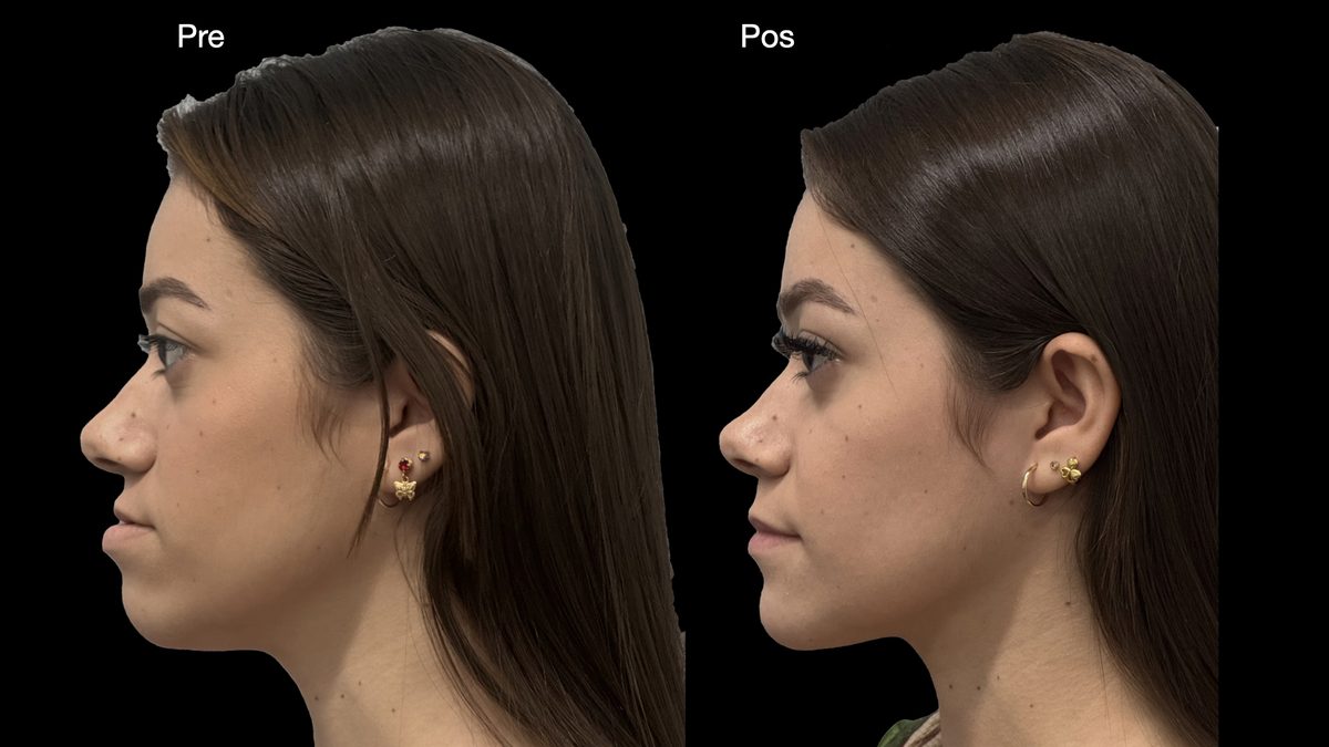Cirurgia ortognática — vista de perfil, registro clínico